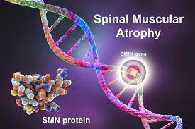 Recognizing Initial Indicators of Spinal Muscle Atrophy (SMA)